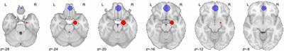 Long-Term Neuroanatomical Consequences of Childhood Maltreatment: Reduced Amygdala Inhibition by Medial Prefrontal Cortex